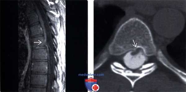 КТ при идиопатической грыже спинного мозга