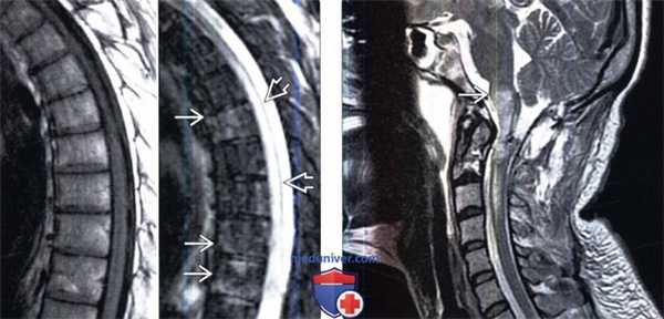 МРТ при инфаркте спинного мозга