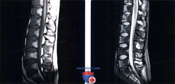 МРТ при инфаркте кости позвоночника