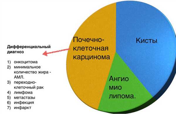 Инфаркт почки