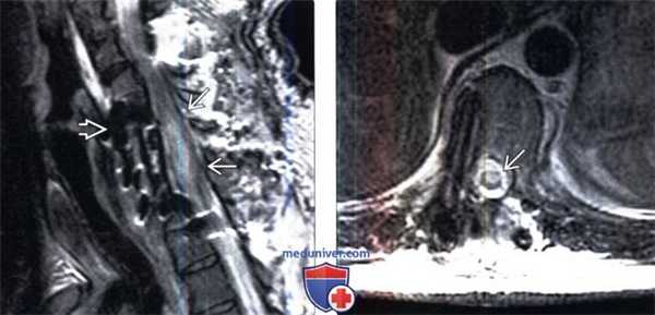 МРТ при инфаркте спинного мозга