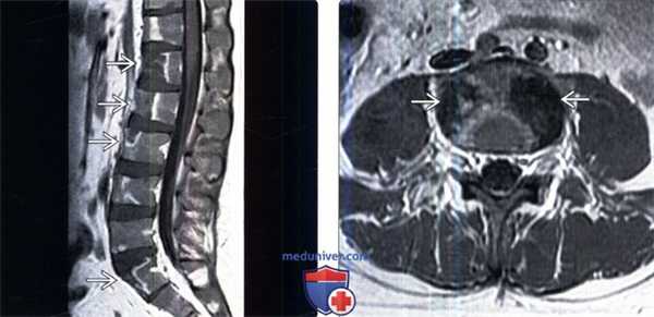 МРТ при инфаркте кости позвоночника