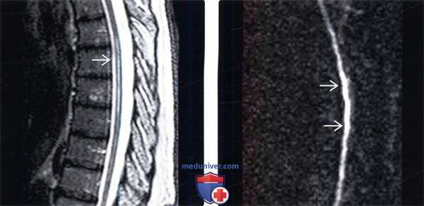 МРТ при инфаркте спинного мозга