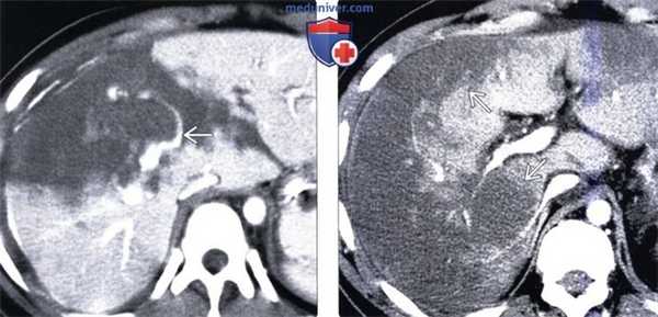 КТ, МРТ, УЗИ признаки инфаркта печени