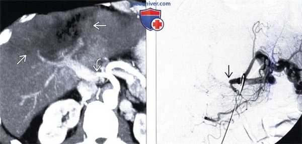 КТ, МРТ, УЗИ признаки инфаркта печени