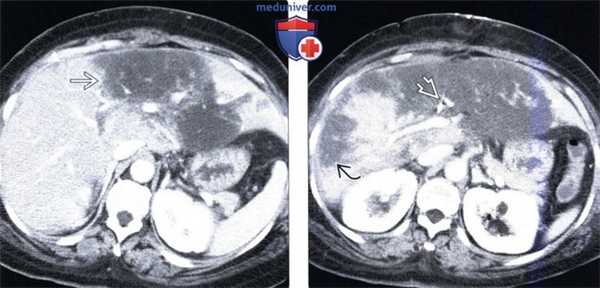 КТ, МРТ, УЗИ признаки инфаркта печени