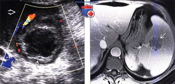 Рентгенограмма, КТ, МРТ, УЗИ при инфекции и абсцессе селезенки