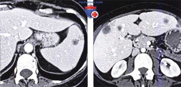 Рентгенограмма, КТ, МРТ, УЗИ при инфекции и абсцессе селезенки