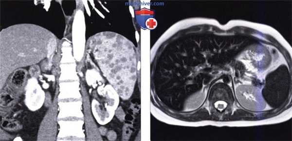 Рентгенограмма, КТ, МРТ, УЗИ при спленомегалии и гиперспленизме