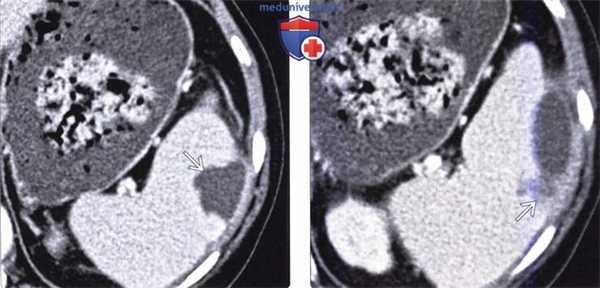 Рентгенограмма, КТ, МРТ, УЗИ при инфекции и абсцессе селезенки