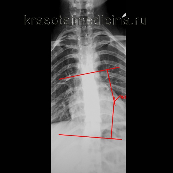 Рентгенография грудного отдела позвоночника. Левосторонний сколиоз 2-й ст. с углом дуги около 15,8 градусов (по Коббу), с центром на Th9.