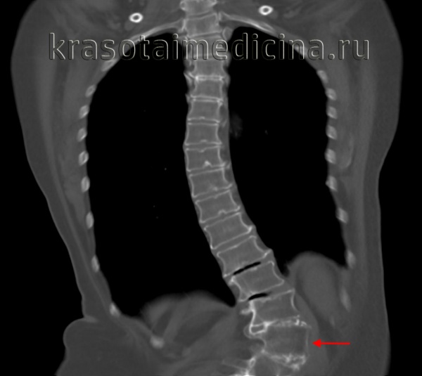 КТ ОГК. Выраженная левосторонняя сколиотическая деформация грудо-поясничного перехода.