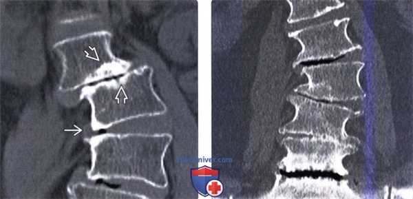 КТ при дегенеративном сколиозе позвоночника