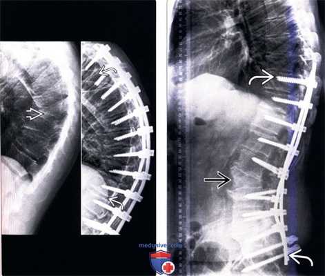 Рентгенограмма после инструментальной стабилизации сколиоза позвоночника