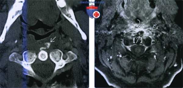 Острый кальцифицирующий тендинит сухожилия длинной мышцы шеи - лучевая диагностика