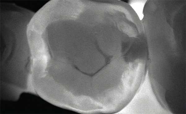 Рис. 2. Сохраненное изображение просвеченного зуба, полученное при обследовании с помощью KaVo DIAGNOcam.