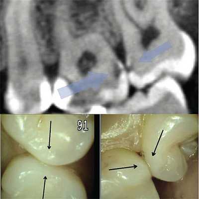Рис. 2. При обследовании контактного пункта зубов 26, 27 (нижний фрагмент) кариес визуально не определяется; на сагиттальном реформате компьютерной томограммы в области проксимальных к контактному пункту поверхностей тех же зубов деминерализация очевидна.