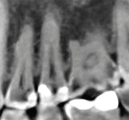 Рис. 9. Сагиттальный реформат области премоляров и моляров, 1 — кариозный процесс, 2 — артефакты (пояснение в тексте).