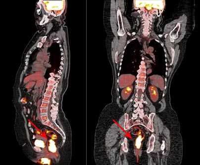 pet-ct-fdg-02.jpg