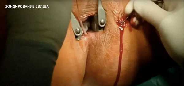 Зондирование свища
