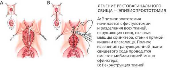 Лечение ректовагинального свища - эпизиопроктотомия