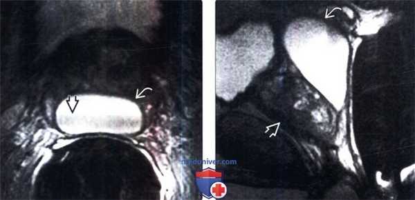 МРТ, УЗИ при кисте предстательной железы