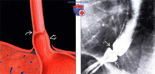 Лучевая диагностика кольца Шацкого