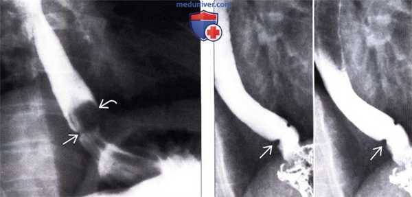 Лучевая диагностика кольца Шацкого