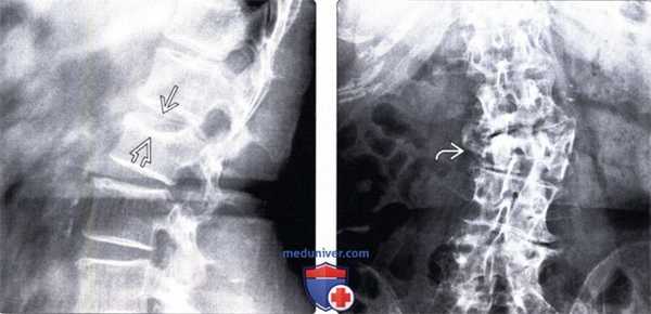 Рентгенограмма при компрессионном переломе позвонка с латеральной компрессией