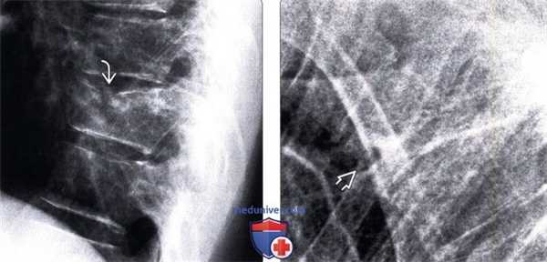 Рентгенограмма при компрессионном переломе позвонка с передней компрессией