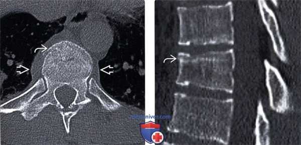 КТ при компрессионном переломе позвонка с передней компрессией