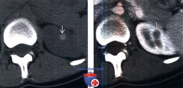 КТ, МРТ, УЗИ при кисте почки