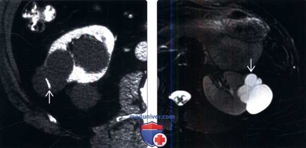 КТ, МРТ, УЗИ при кисте почки