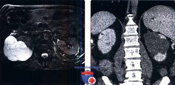КТ, МРТ, УЗИ при локализованной кистозной болезни почек