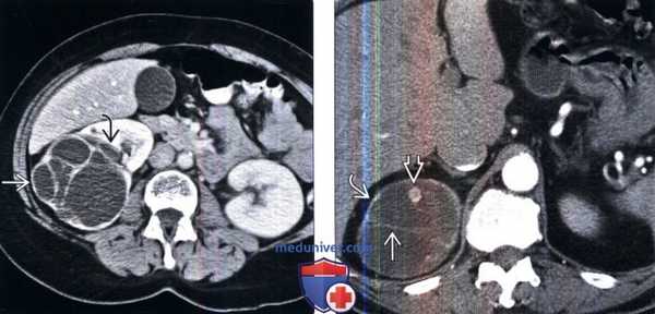 КТ, МРТ, УЗИ при кисте почки