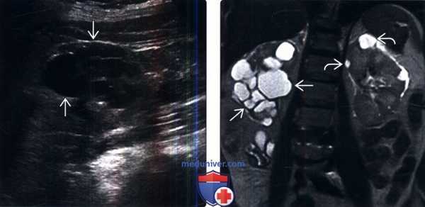 КТ, МРТ, УЗИ при локализованной кистозной болезни почек