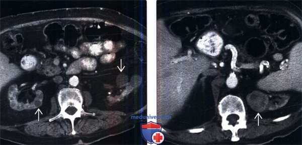 КТ, МРТ, УЗИ при уремической кистозной болезни почек