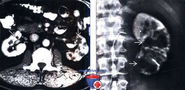 КТ, ангиография, УЗИ при медуллярной кистозной болезни почек