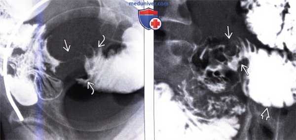 Лучевая диагностика рака тонкой кишки
