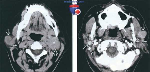 КТ, МРТ при метастазах в околоушную железу