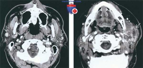 КТ, МРТ при метастазах в околоушную железу