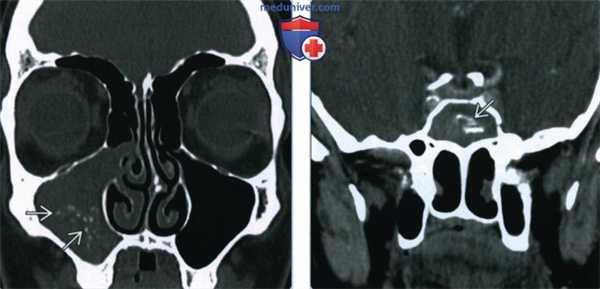 Мицетома пазух - лучевая диагностика
