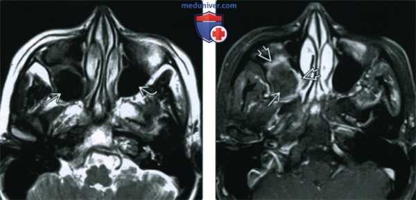 Мицетома пазух - лучевая диагностика