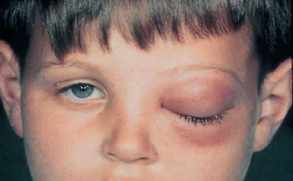 Флегмона орбиты