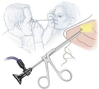 Эндоскопическое вскрытие