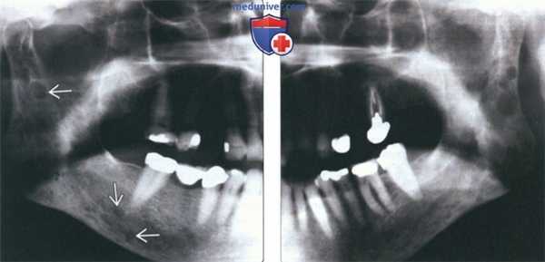 Рентгенограмма, КТ при множественной миеломе челюсти