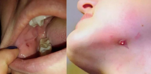 Свищ слюнной железы