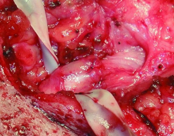 Восстановление протока слюнной железы