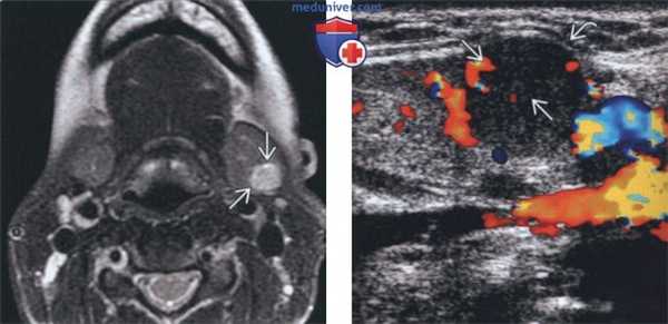 Лучевая диагностика доброкачественной смешанной опухоли поднижнечелюстной железы