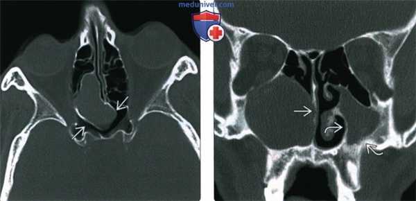 КТ, МРТ при мукоцеле пазух носа